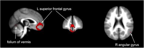 Frontiers Effects Of Acupuncture On The Brain In Primary Insomnia A