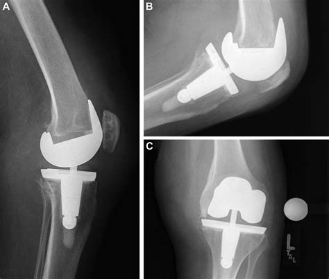 Clinical Outcomes Following The Use Of Constrained Condylar Knees In