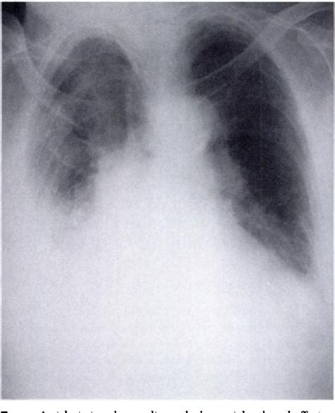 Tension Pyopneumothorax Rare Presentation Of Ruptured Barrett S