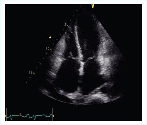 Soporte Circulatorio Con Ecmo Venoarterial En Paciente Con