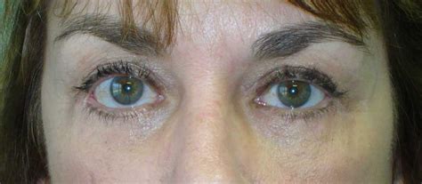 Mid Facelift Photos | M. Douglas Gossman, MD, PLLC | Eyelid Surgery