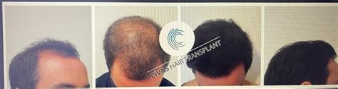 Civas Hair Transplant Dr Ekrem Civas 5700 3200 2500 Grafts Fue 1