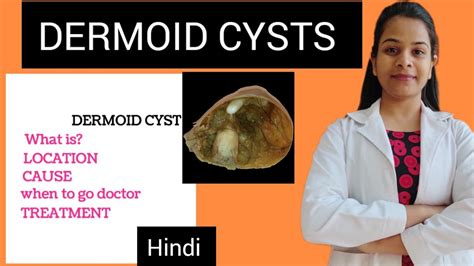 Dermoid Cysts Lecture In Hindi Easy Explanation Location Causes