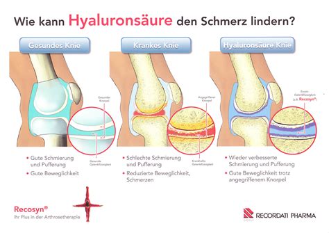 Moderne Arthrose-Therapie in der ORTHO PRAXIS Lübeck