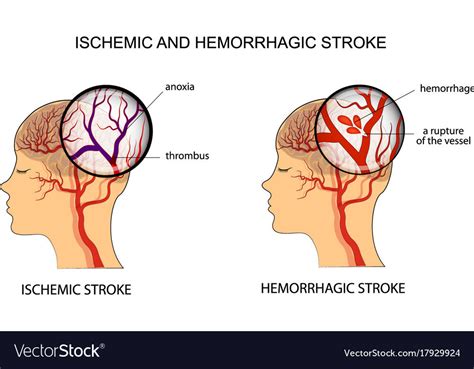 stroke — Chronic Care Exercise Physiology Services