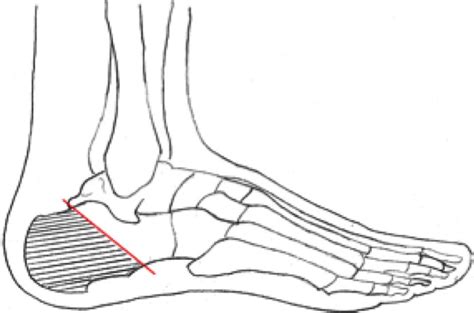 Diagram showing the bone resection for partial calcanectomy. | Download Scientific Diagram