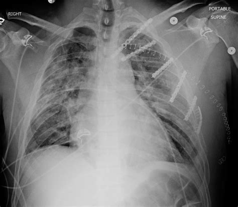 Sternoclavicular Dislocation Trauma Orthobullets