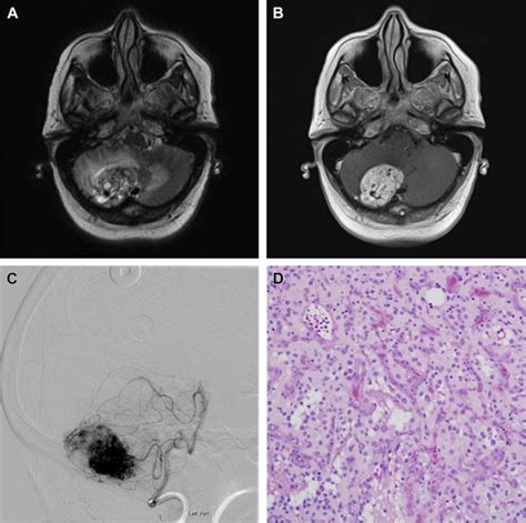 Posterior Fossa Tumors In Adult Patients Neuroimaging Clinics