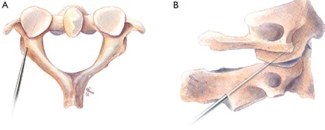 Illustration Of Pedicle Screw Fixation Insertion Of C1 Lateral Mass Download Scientific