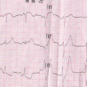 de Winter T-waves – ECG Weekly