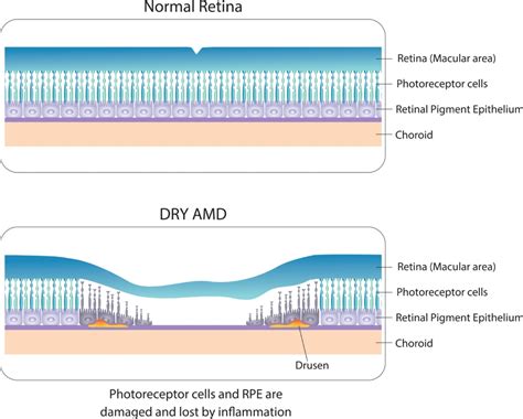 What is Wet Macular Degeneration? | Eye Consultants of Fargo