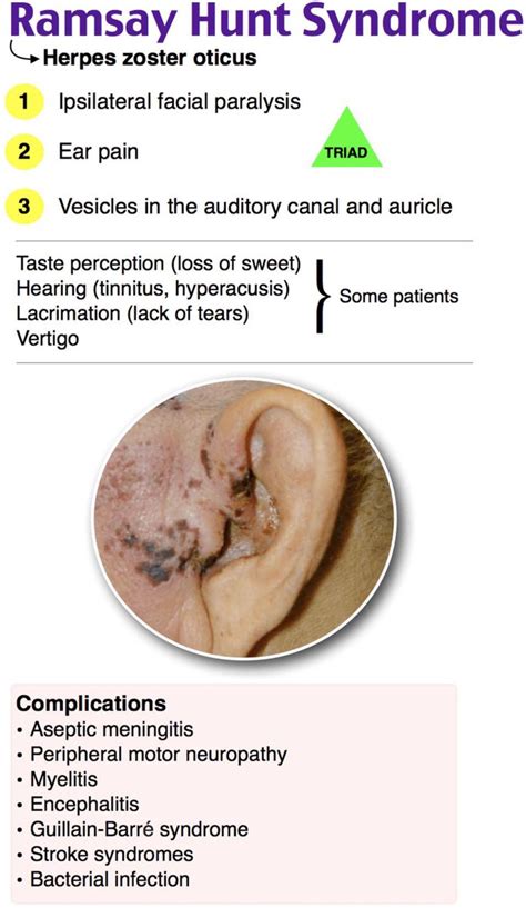 Keith Siau On Twitter Ramsay Hunt Is Known As Herpes Zoster Oticus As