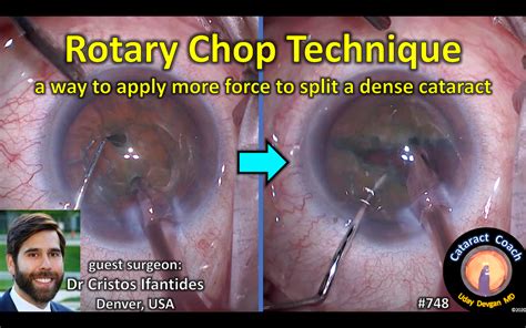 Rotary Chop 748 Cataract Coach™