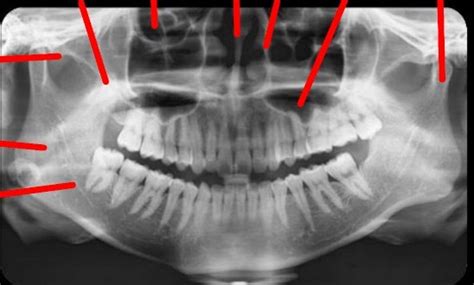 Radiografia Panoramica Adulto Diagram Quizlet