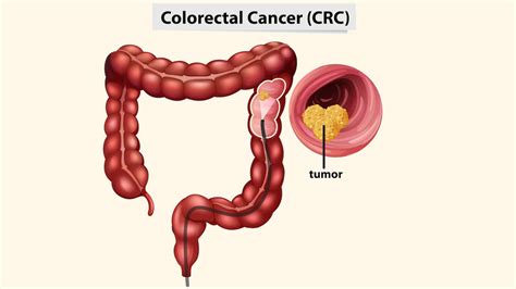 Colorectal Cancer Symptoms Causes And Treatment Off