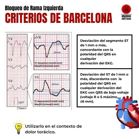 Criterios Barcelona Bloqueo De Rama Izquierda Informaci N M Dica