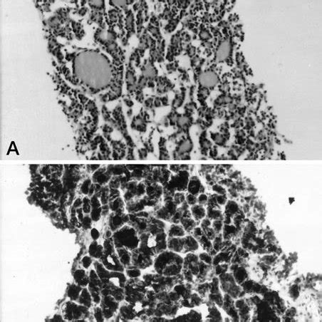 Bone Core Biopsy Showing Metastatic Follicular Patterned Tumor A