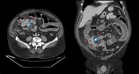 Figure 1 From Ct Evaluation Of Small Bowel Carcinoid Tumors Semantic Scholar