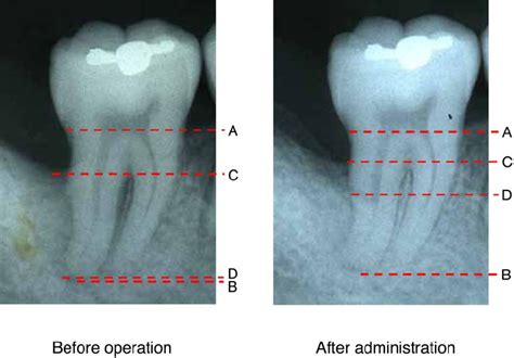 Alveolar Crest Radiograph