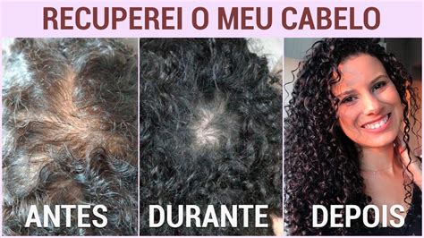 Queda De Cabelo O Que Fazer Para Parar De Cair Fotos De Antes E