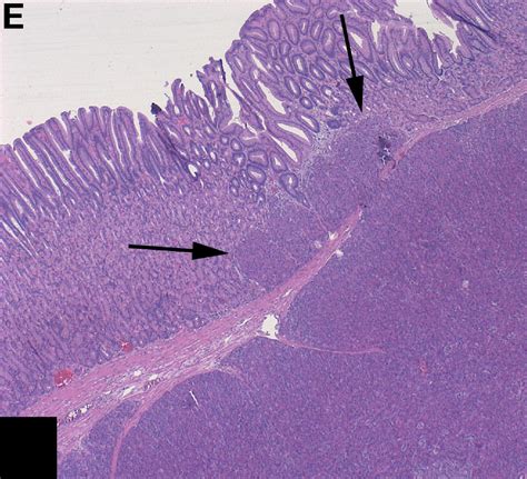 Gastric Submucosal Tumor A Common Finding In An Atypical Location