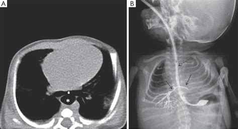 Tracheoesophageal Fistula Ultrasound