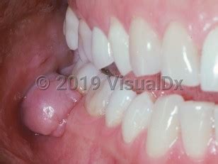 Peripheral ossifying fibroma