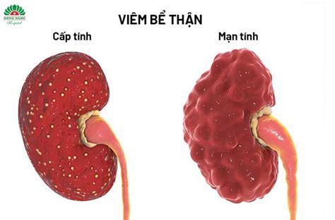 TỔNG QUAN Viêm thận bể thận Triệu chứng nguyên nhân và cách điều trị