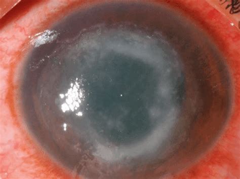 Acanthamoeba Corneal Ulcer