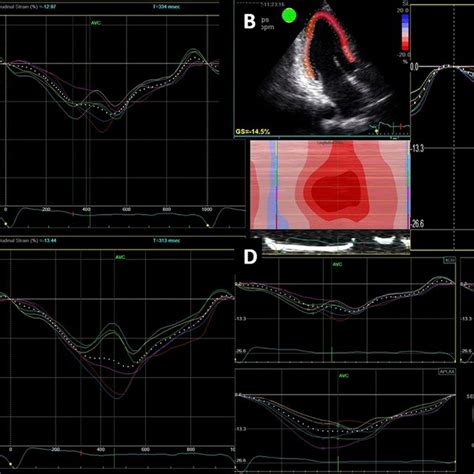 Peak Systolic Longitudinal Strain Of The Lv Obtained At Apical