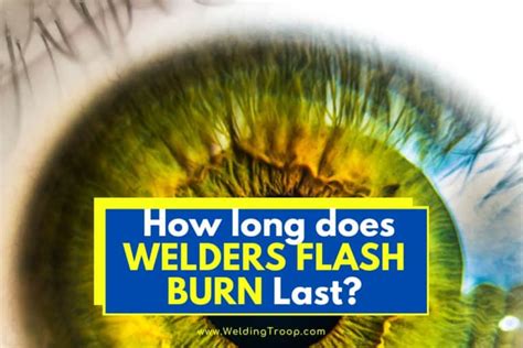 How Long Does Welders Flash Burn Last? Symptoms and Treatments