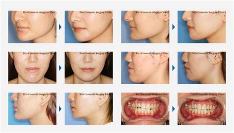 オトガイ（あご）延長（顎を長くする） 症例 顎矯正手術 Drヒロヒの顔面骨形成術