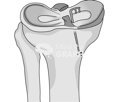 Meniscus root tear repair