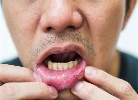 Hiv Mouth Sores Pictures Causes Treatment And 51 Off