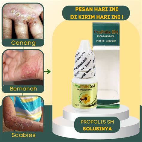 Jual Obat Scabies Manusia Obat Scabies Manusia Obat Herpes Kulit