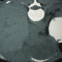 Non-enhanced scan in the supra-pancreatic region showing exophytic mass ...