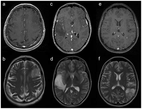 Pattern Of Contrast Enhancement Ce On Magnetic Resonance Imaging