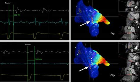 CARDIAC ELECTROPHYSIOLOGY | Dr.PL. Saravanan Cardiologist