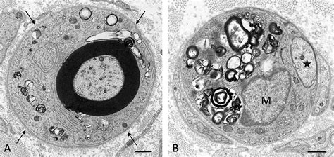 Nerve Biopsy In Acquired Neuropathies Sommer 2021 Journal Of The