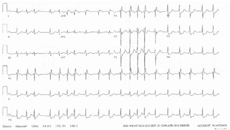 Atrial Fibrillation With Rapid Ventricular Response