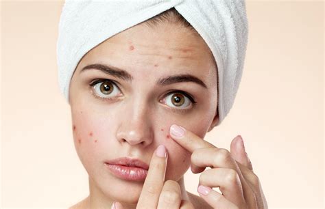 Acne Pimple Treatment Welona