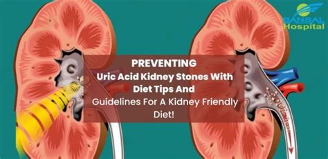 Preventing Uric Acid Kidney Stones With Diet Bansal Hospital