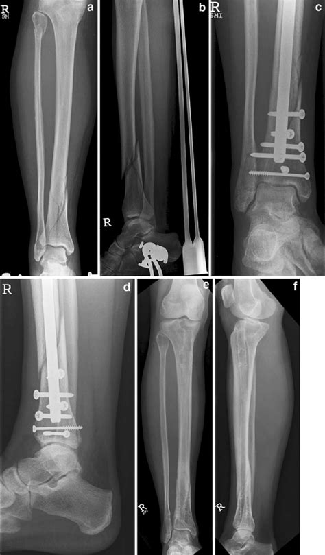 A Year Old Female Sustained An Ao C Distal Tibia Fracture After