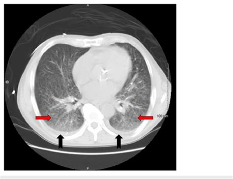 Ct Scan Of The Chest Axial View Lung Window At The Level Of The