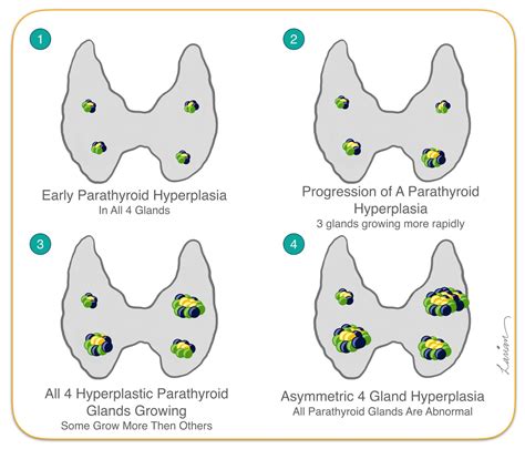 Parathyroid Hyperplasia Growth in Cells of Parathyroid Gland ...