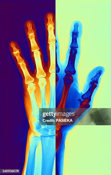 Degenerative Joint Disease Photos And Premium High Res Pictures Getty Images