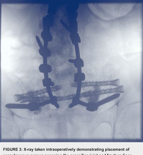 Figure 1 From A Case Of U Shaped Sacral Fracture After Longstanding Spinopelvic Fixation Treated