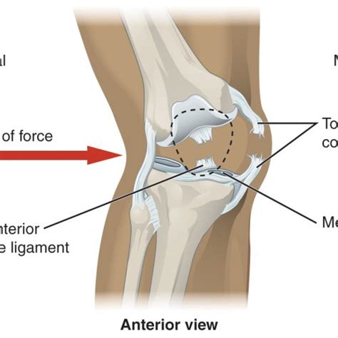 Allograft vs Autograft ACL, Which Is Better?