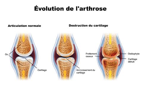 L Arthrose Causes Sympt Mes Pr Vention Et Traitement De L Arthrose