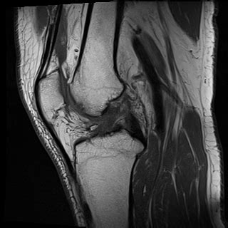 Baker Cyst Image Radiopaedia Org